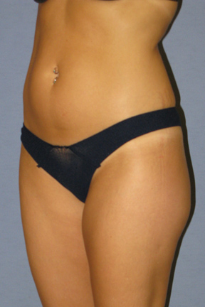 Liposuction Before & After Patient #3508