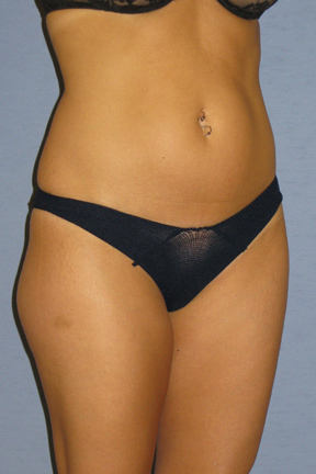 Liposuction Before & After Patient #3508