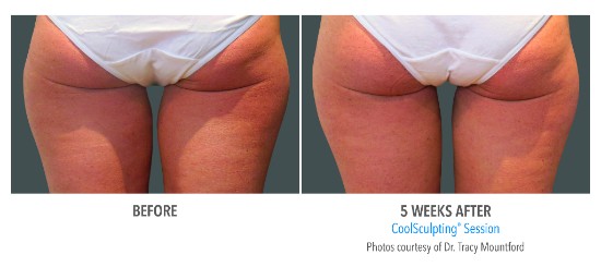 coolsculpting before and after