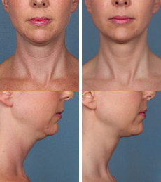 Kybella