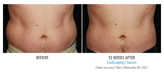 coolsculpting before and after