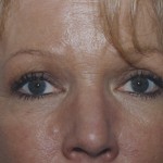 Eyelid Surgery Before & After Patient #4546