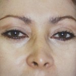 Eyelid Surgery Before & After Patient #4577