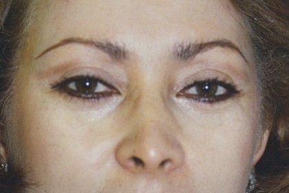 Eyelid Surgery Before & After Patient #4577