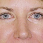 Eyelid Surgery Before & After Patient #4563