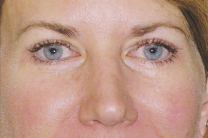 Eyelid Surgery Before & After Patient #4563