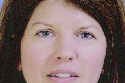 Eyelid Surgery Before & After Patient #4569