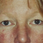 Eyelid Surgery Before & After Patient #4546