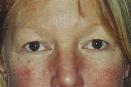 Eyelid Surgery Before & After Patient #4546