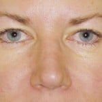 Eyelid Surgery Before & After Patient #4563