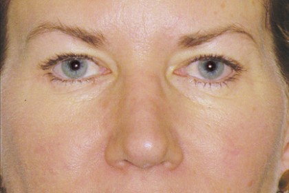 Eyelid Surgery Before & After Patient #4563