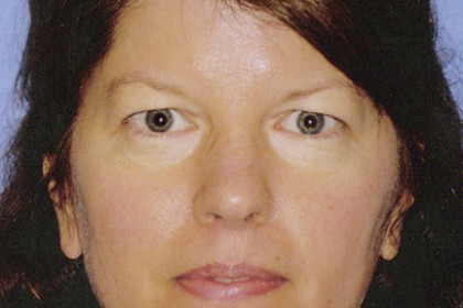 Eyelid Surgery Before & After Patient #4569
