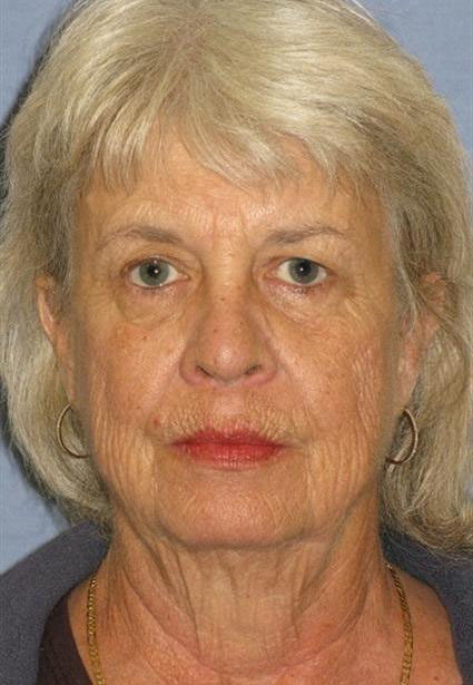 Quick Lift Before & After Patient #1484