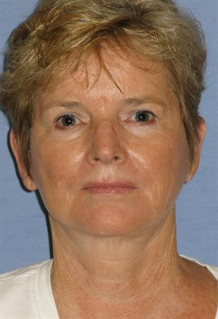 Quick Lift Before & After Patient #1463