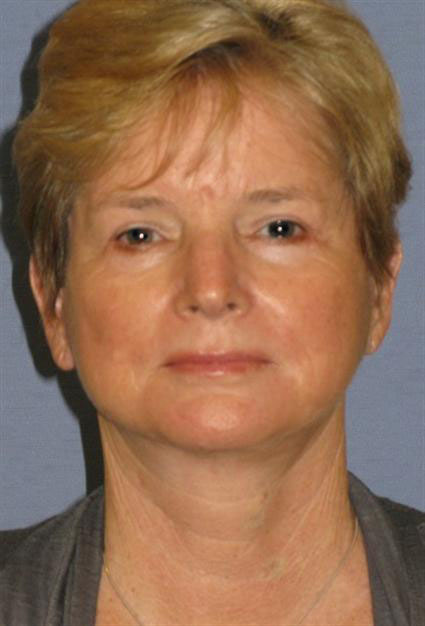 Quick Lift Before & After Patient #1463