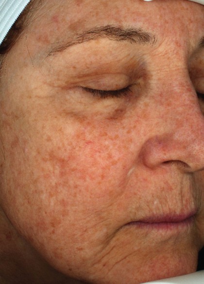 Before & After Patient #4661