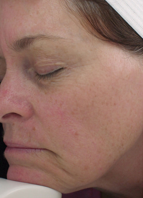 Halo Laser Before & After Patient #4664