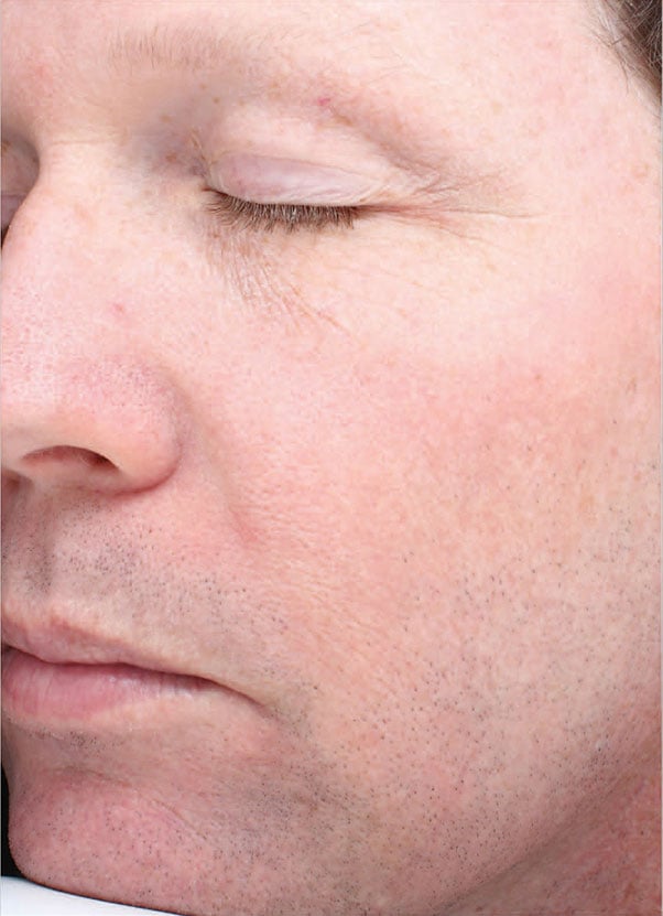 Halo Laser Before & After Patient #4673