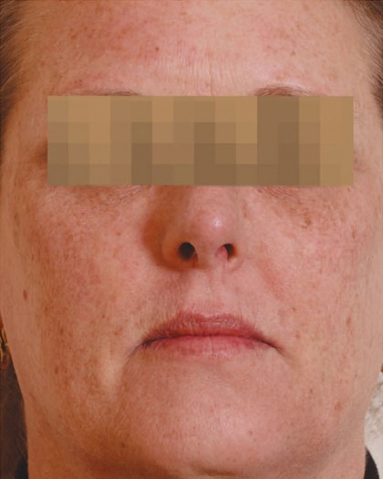 Halo Laser Before & After Patient #4676