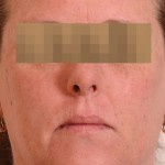 Halo Laser Before & After Patient #4676