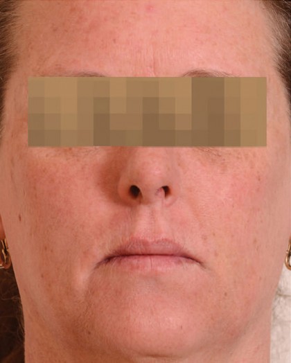 Halo Laser Before & After Patient #4676