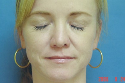 Injectables Before & After Patient #4524