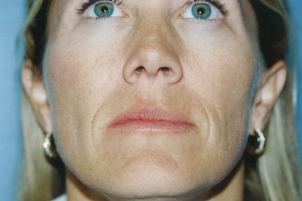 Injectables Before & After Patient #4521