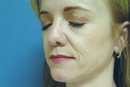 Injectables Before & After Patient #4524