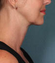 Kybella Before & After Patient #4728