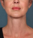 Kybella Before & After Patient #4728
