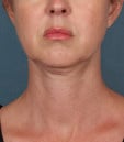 Kybella Before & After Patient #4728