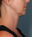 Kybella Before & After Patient #4728