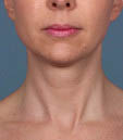 Kybella Before & After Patient #4718