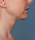 Kybella Before & After Patient #4718
