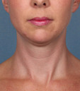 Kybella Before & After Patient #4718
