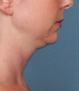 Kybella Before & After Patient #4718