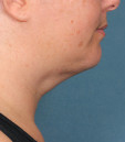 Kybella Before & After Patient #4705