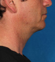 Kybella Before & After Patient #4733