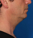 Kybella Before & After Patient #4733