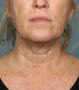 Kybella Before & After Patient #4700