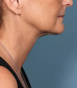 Kybella Before & After Patient #4695