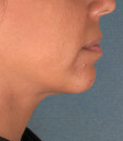 Kybella Before & After Patient #4690