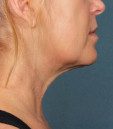 Kybella Before & After Patient #4700