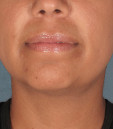 Kybella Before & After Patient #4690