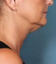 Kybella Before & After Patient #4695