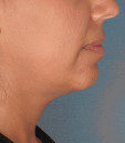 Kybella Before & After Patient #4690