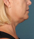 Kybella Before & After Patient #4700