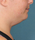 Kybella Before & After Patient #4705