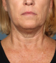 Kybella Before & After Patient #4700