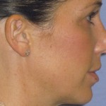 Rhinoplasty Before & After Patient #4614